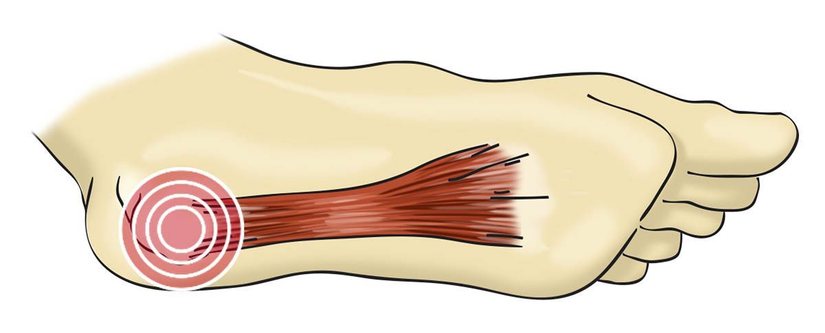 De training die je helpt fasciitis plantaris te voorkomen